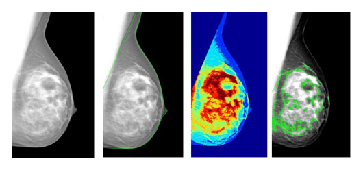 Digital mammogram and automated dense tissue segmentation by LIBRA